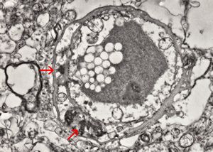 M,71y. | CADASIL accompanied with Alzheimer disease - brain vessel - arrows: granular osmiophilic material (GOM) between basement membranes